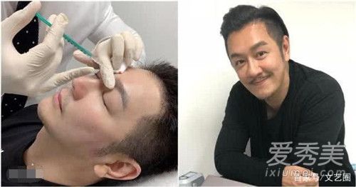 陈浩民承认整容是什么情况 陈浩民整容前后对比