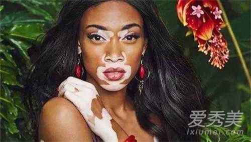 白癜风超模是谁个人资料照片 白癜风超模人品