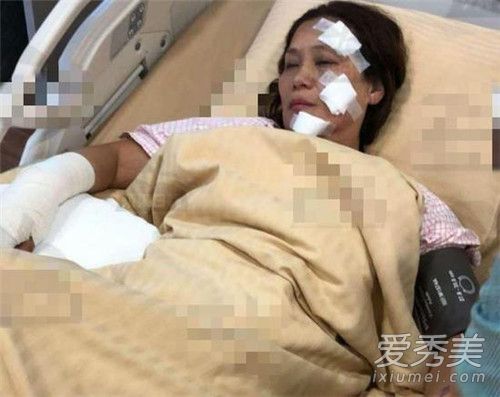 杨盼盼烧伤首开腔是怎么回事 杨盼盼烧伤首开腔说了什么