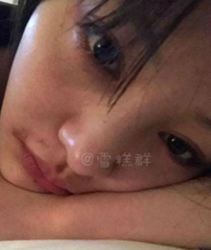 郑爽嘴角的伤好了吗 郑爽嘴角伤疤原因图片