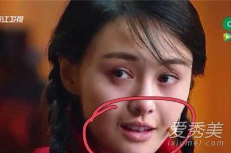 郑爽嘴角的伤好了吗 郑爽嘴角伤疤原因图片