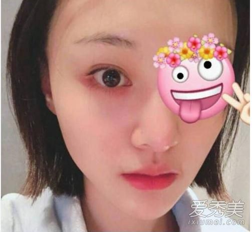 郑爽眼睛受伤 右眼肿起贴纱布出席活动
