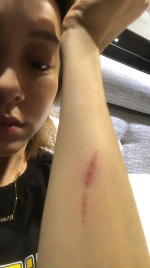 范玮琪意外摔倒 胳膊和腿都淤青伤势不轻