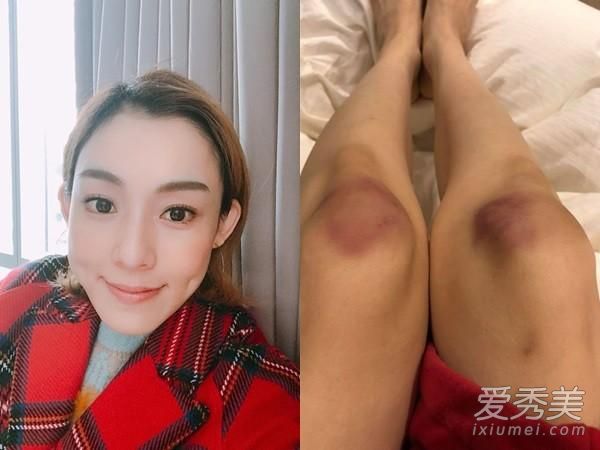 范玮琪意外摔倒 胳膊和腿都淤青伤势不轻