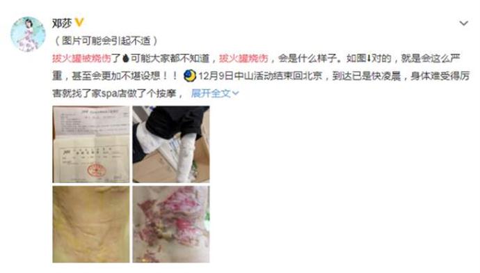 邓莎拔火罐被烧伤 现场照曝出皮肉外翻太吓人了