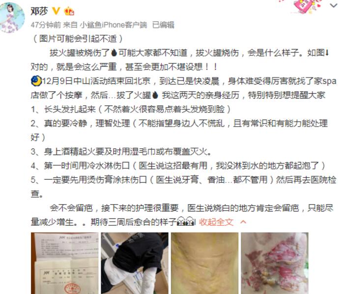 邓莎拔火罐被烧伤 事件详情曝光手臂伤势吓人