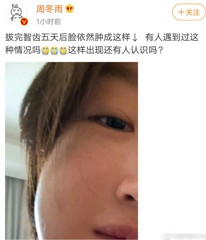 周冬雨脸肿如馒头 为什么脸那么肿详细情况曝光