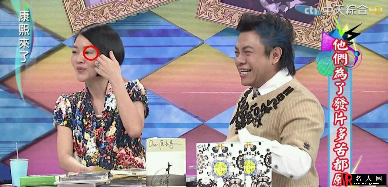小s再陷家暴传言 左眼冒出大块淤青(1)